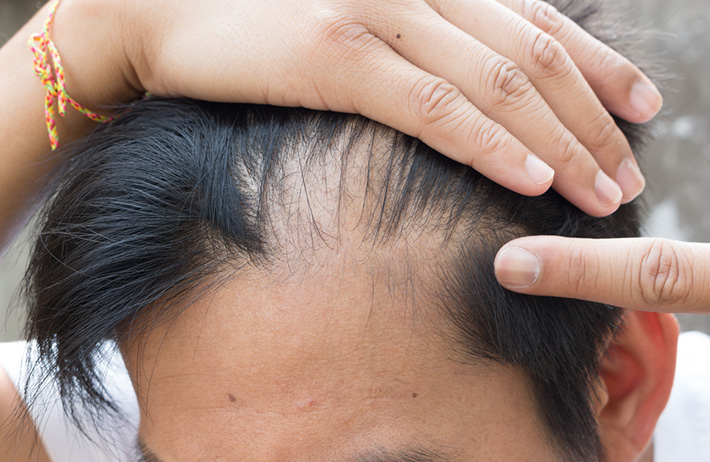 Hair Shedding vs. Hair Loss: How to Tell the Difference