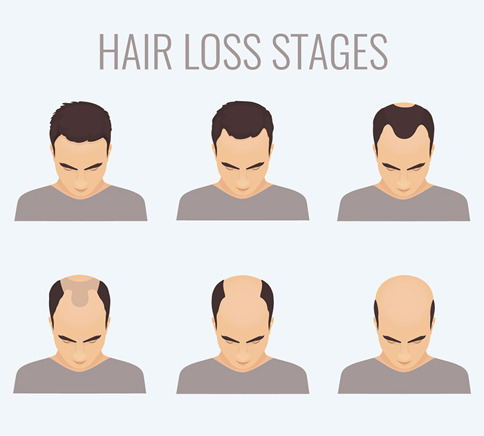 How Much Hair Loss is Normal: A Guide for Young Gents | The Bald Gent