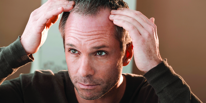 Vitamin D Deficiency and Hair Loss – The Things you Need to Know | The Bald  Gent