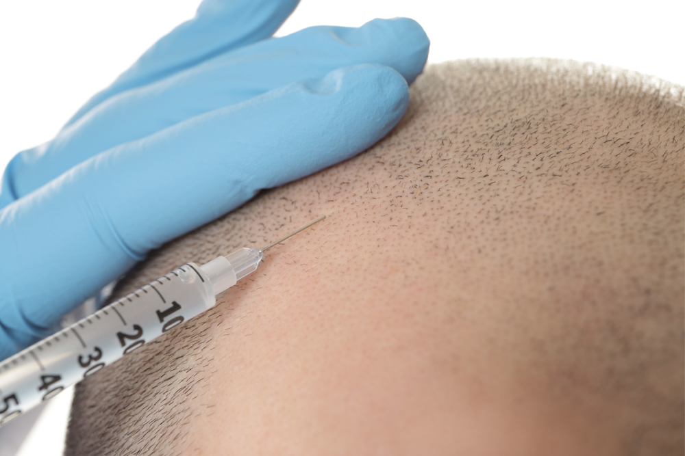 Hair Transplants: Horrific Side Effects and 9 Reasons to Avoid | The Bald  Gent